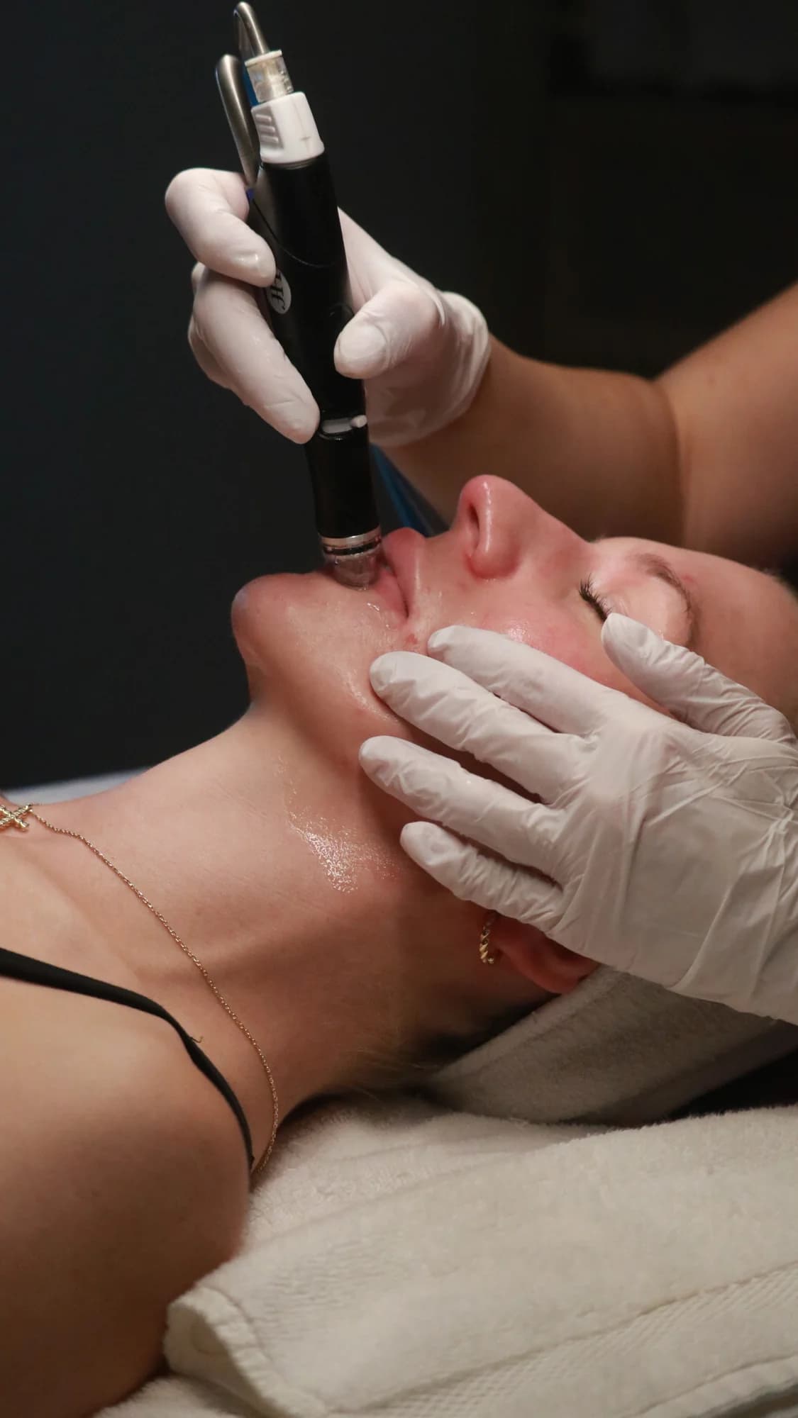 Stock photo — hydrafacial treatment in progress