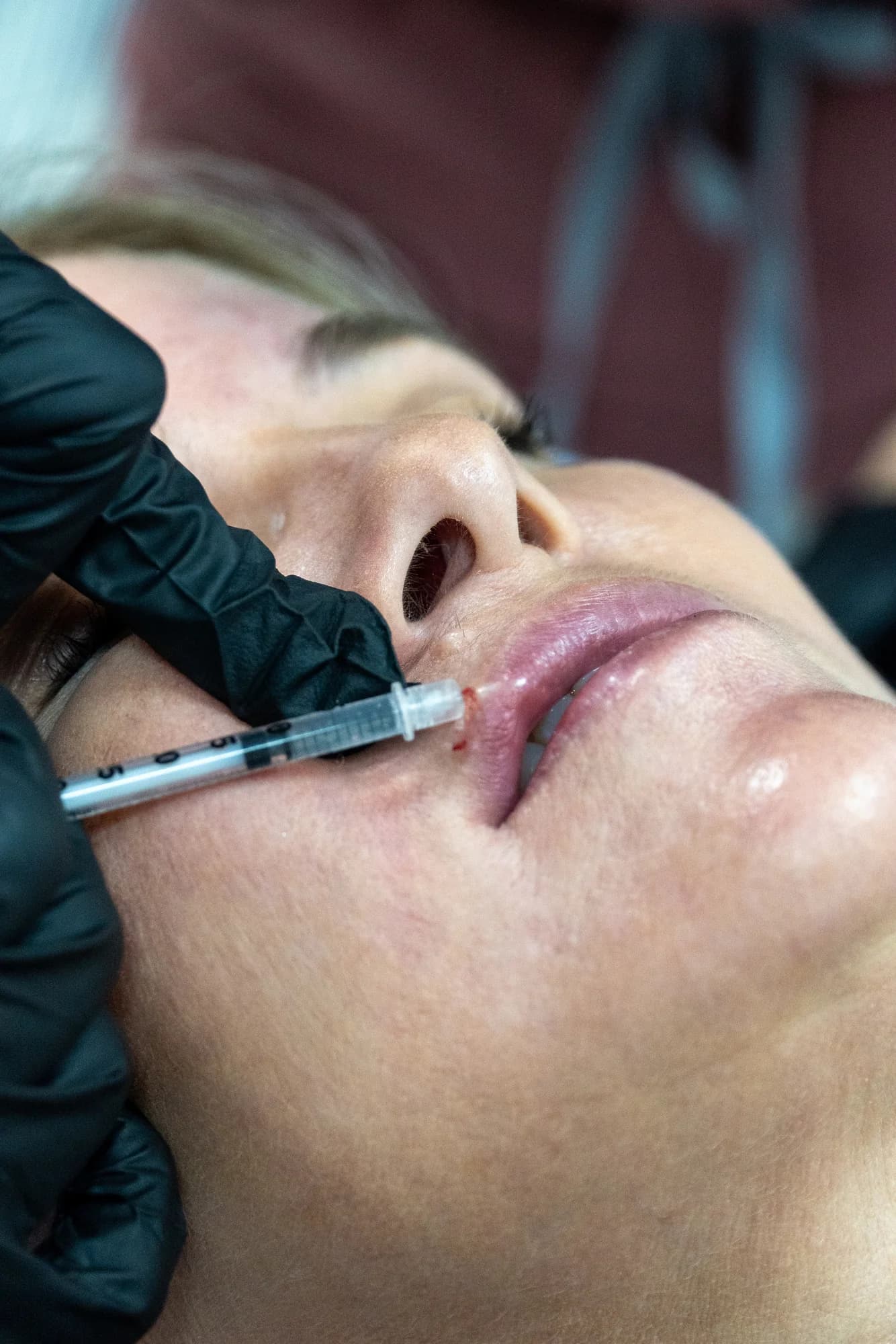 Stock photo — patient receiving a lip filler injection